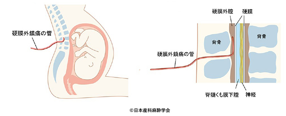 硬膜外鎮痛の管を留置する位置を示したイラスト（硬膜外腔・硬膜・脊髄くも膜下腔・神経）